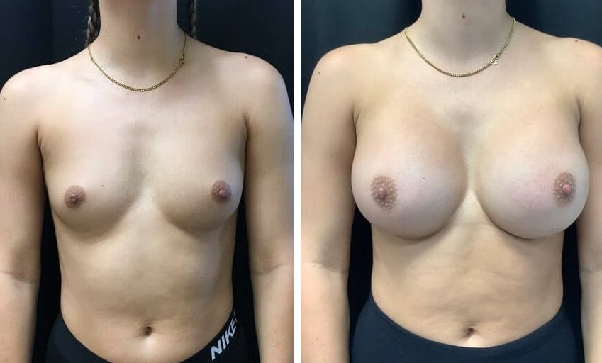 Breast implants before and after pictures cosmetic surgery abroad
