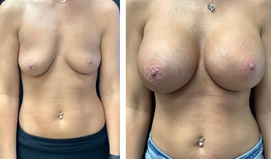 Breast implants before and after pictures cosmetic surgery abroad