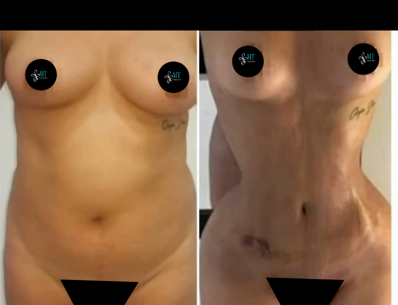 TUMMY TUCK + LIPOSUCTION