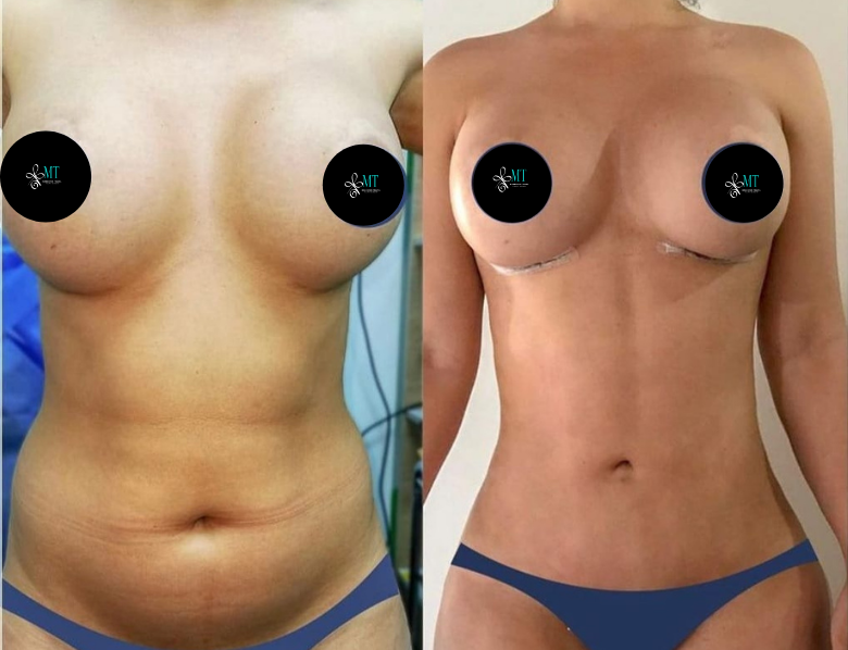 before and after mommy makeover cosmetic surgery vacations