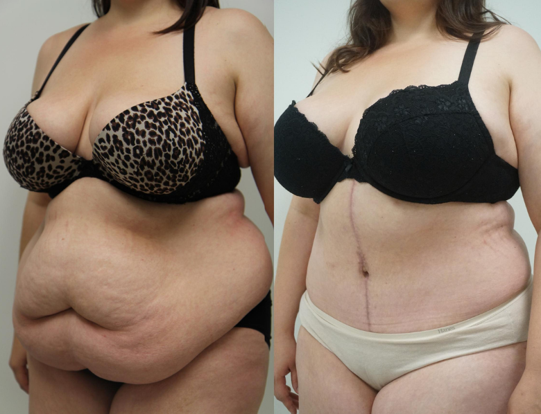 TUMMY TUCK + LIPOSUCTION