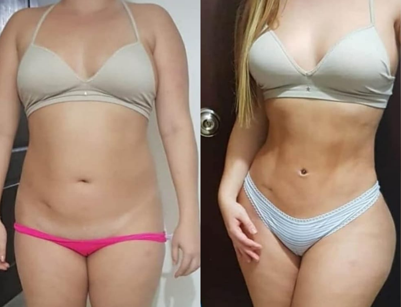 TUMMY TUCK + LIPOSUCTION