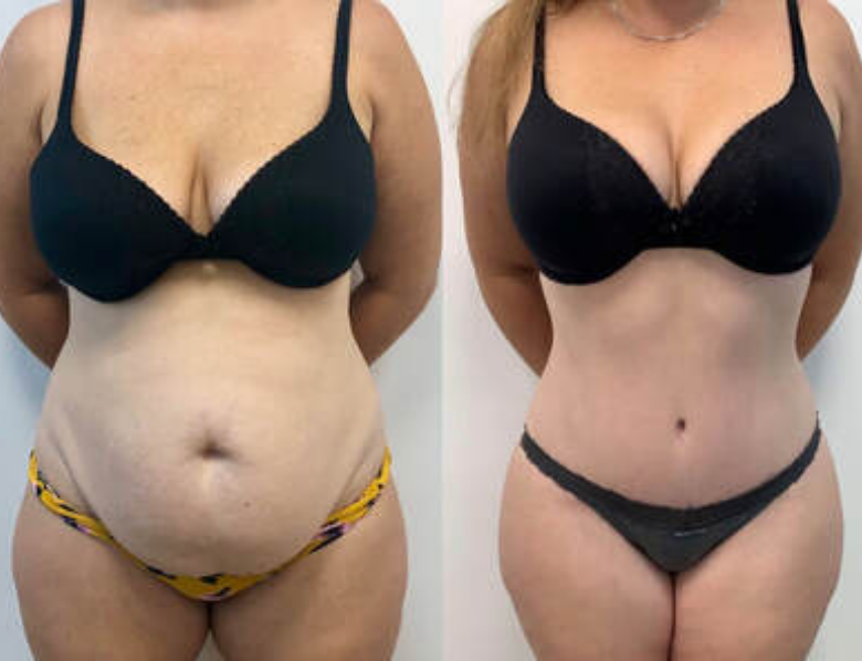 TUMMY TUCK + LIPOSUCTION