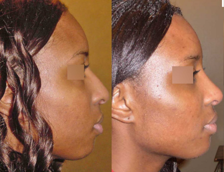 https://cosmeticsurgeryvacationpackages.com/before-and-after-african-american-rhinoplasty/