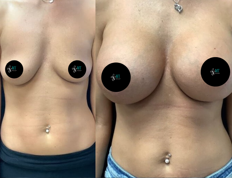 BREAST AUGMENTATION