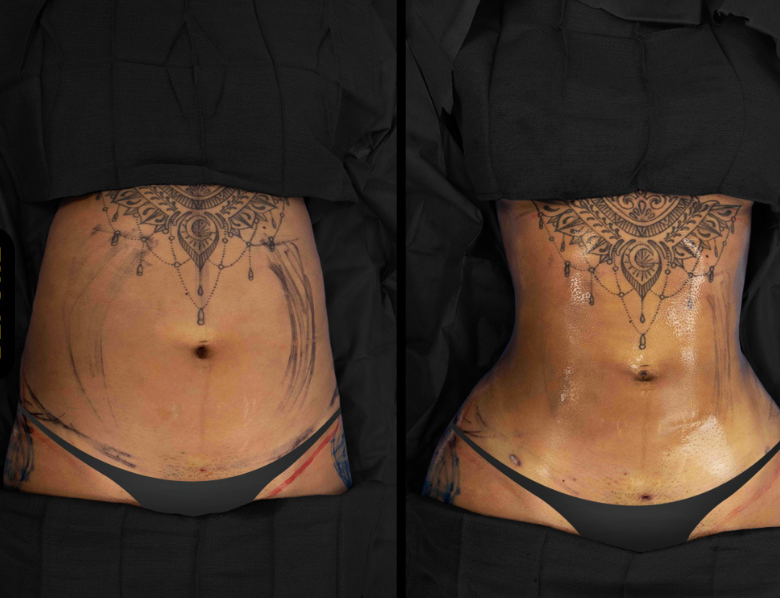 before and after african american liposuction