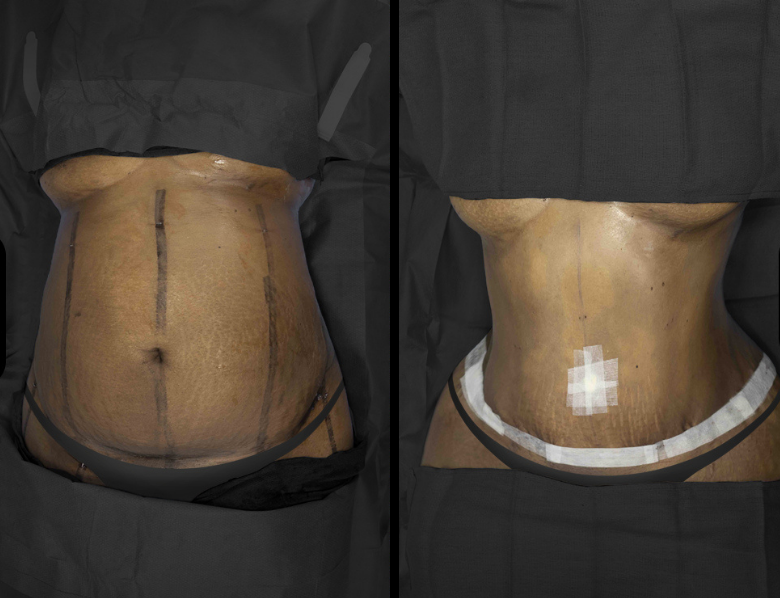 before and after african american liposuction with tummy tuck