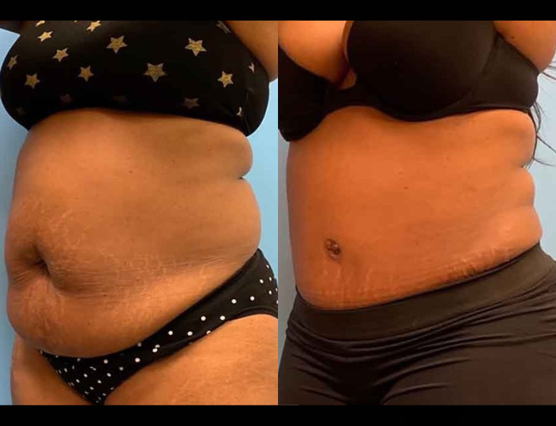 BEFORE AND AFTER LIPOSUCTION WITH TUMMY TUCK 3