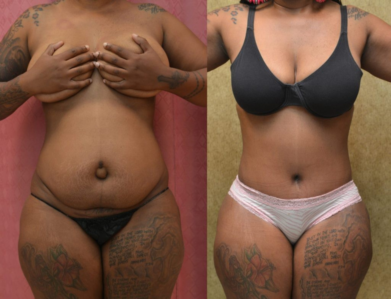 african american tummy tuck with liposuction