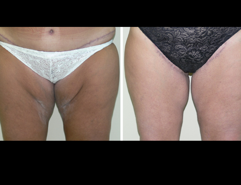 before and after thigh lift