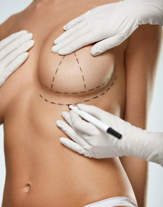 breast-lift- incisions